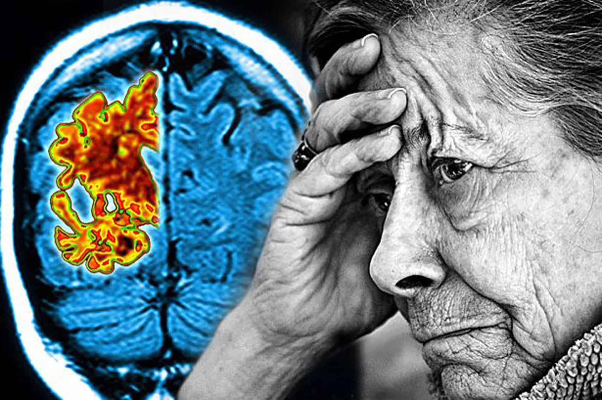 Лекарство от болезни Альцгеймера сработало после того, как его вычеркнули